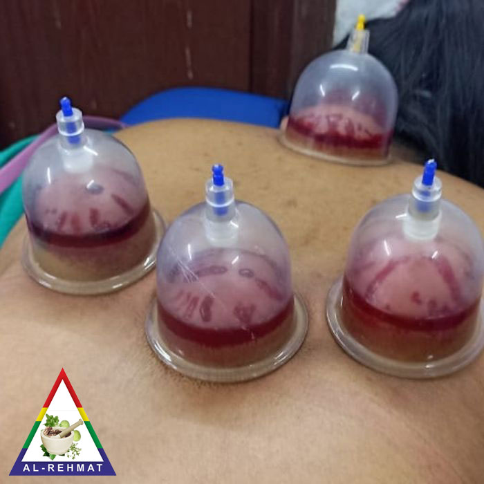 Hijama Cupping In Murad Nagar And Vaishali