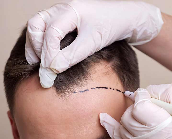 Best Hair Transplant In Delhi