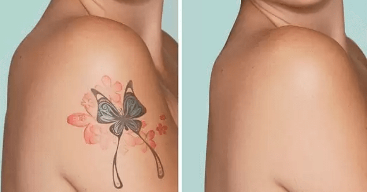 Effective And Safe Tattoo Laser Removal Services