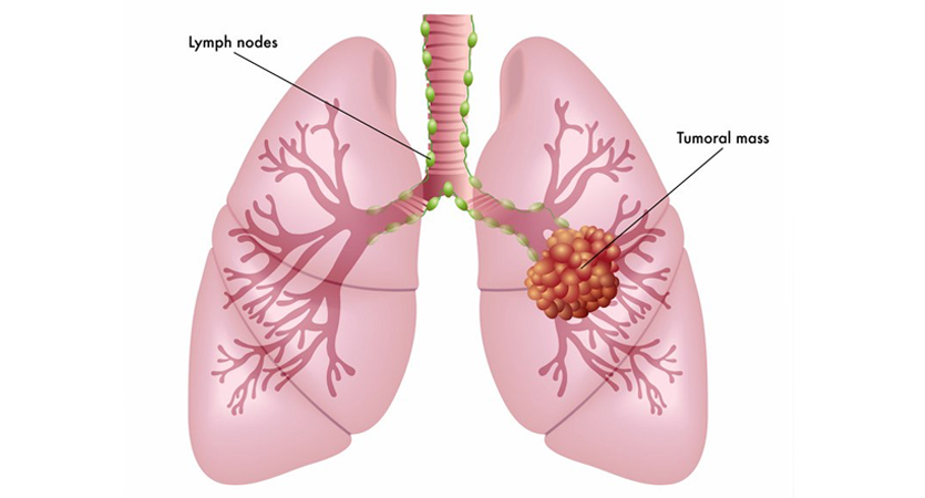 Lung Cancer Treatment In Gurgaon