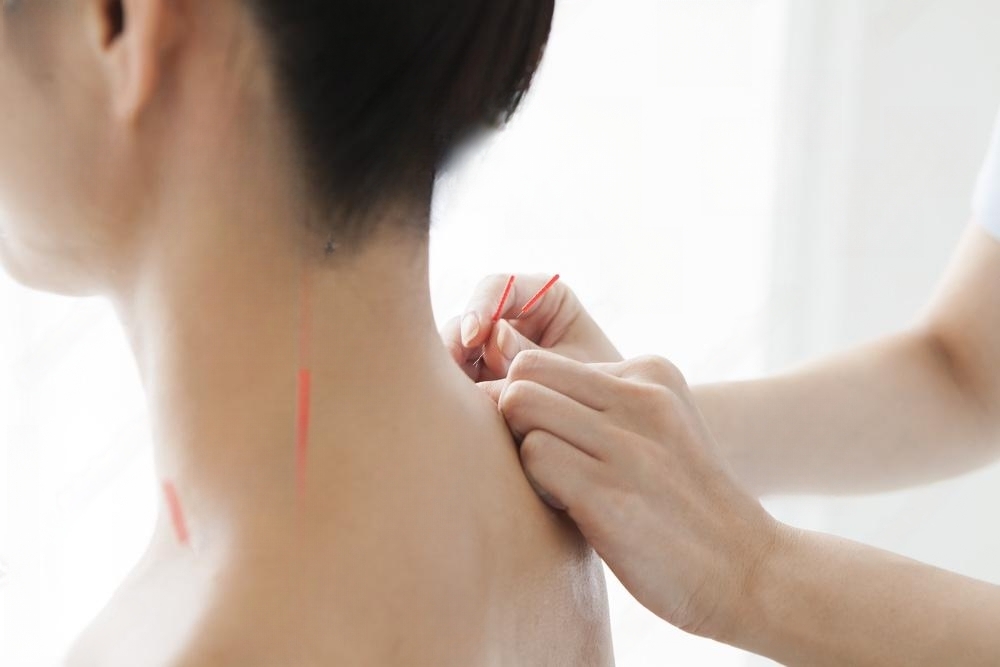 Acupuncture For Neck Stiffness In San Francisco