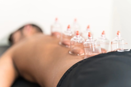 Cupping Therapy In San Francisco