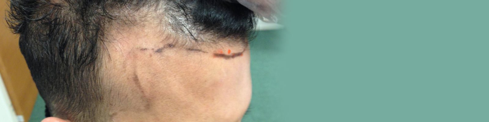 Best Hair Transplant In Delhi By Dr. Dadu