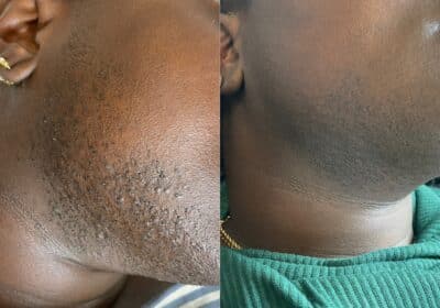Permanently Remove Facial Hair: Discover Lasting Beauty!