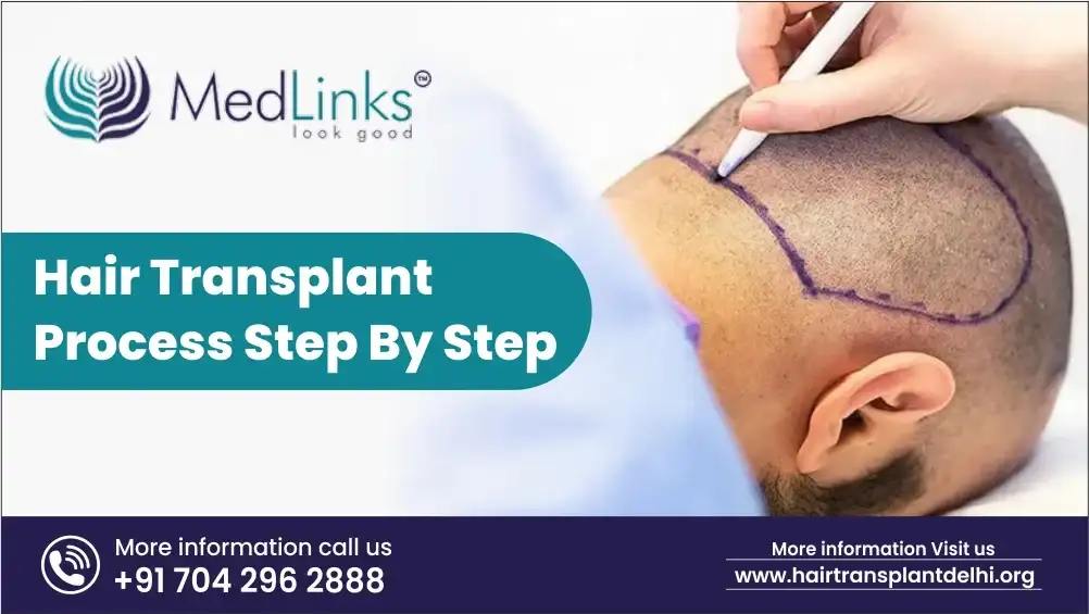 How To Prepare Mentally And Emotionally For A Hair Transplant