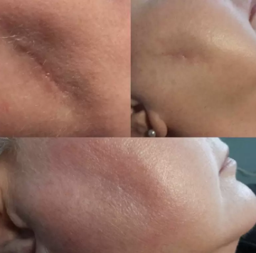 Successful Scar Treatment At Wymore Laser