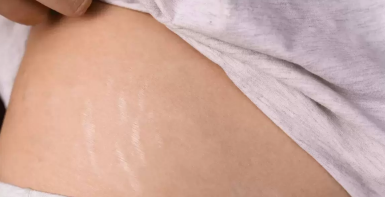 Transform Your Skin With Stretch Mark Treatments