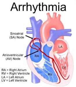 Consider The Holter Monitor Test For Arrhythmia Diagnosis In Long Island!