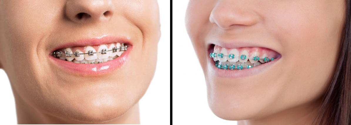 Conventional Braces Treatment Berwick - Woodleigh Waters Dental Surgey