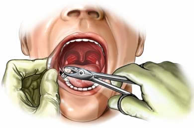 Dental Extractions Berwick - Woodleighwaters Dental Surgery