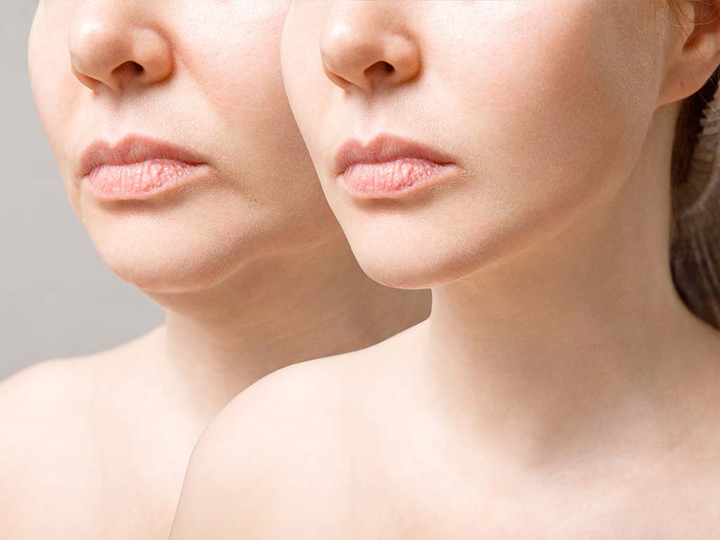 How Surgical Rhinoplasty Can Boost Confidence