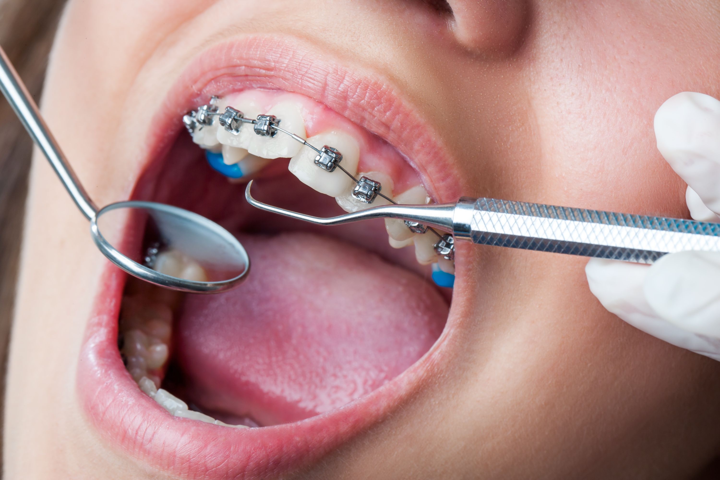 Best Orthodontist Melbourne