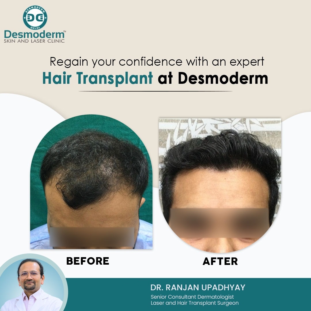 Hair Transplant Cost In Delhi Ncr