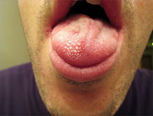 Understanding The Approach: Can You Cut Off Swollen Taste Buds?
