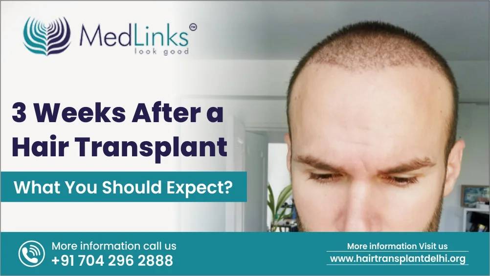 3 Weeks After A Hair Transplant: What You Should Expect?