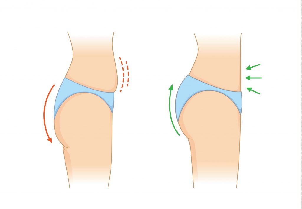 Butt Lift Surgery In Delhi