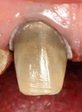 Best Root Canal Treatment In Berwick - Woodleigh Waters Dental Surgery