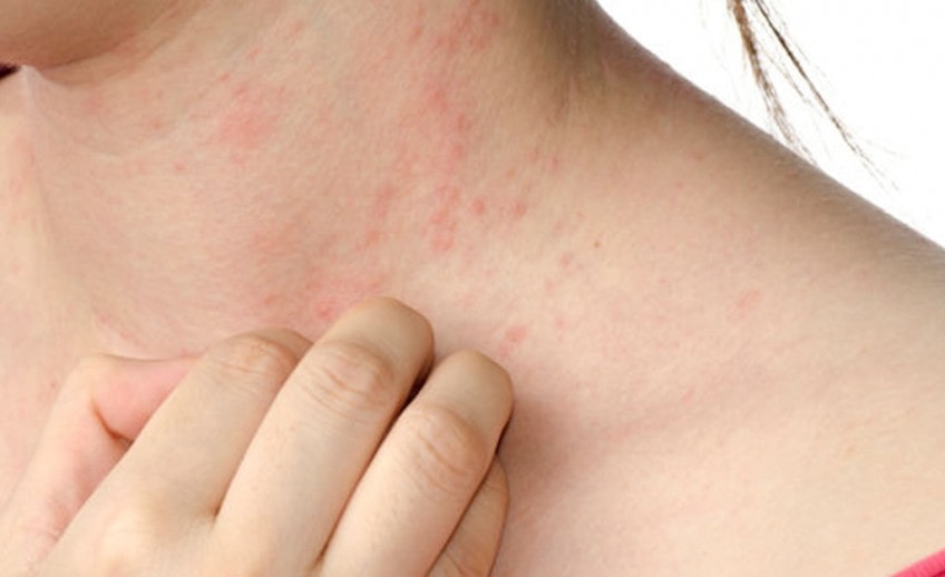 Best Urticaria Treatment In Delhi At Skinology Clinic